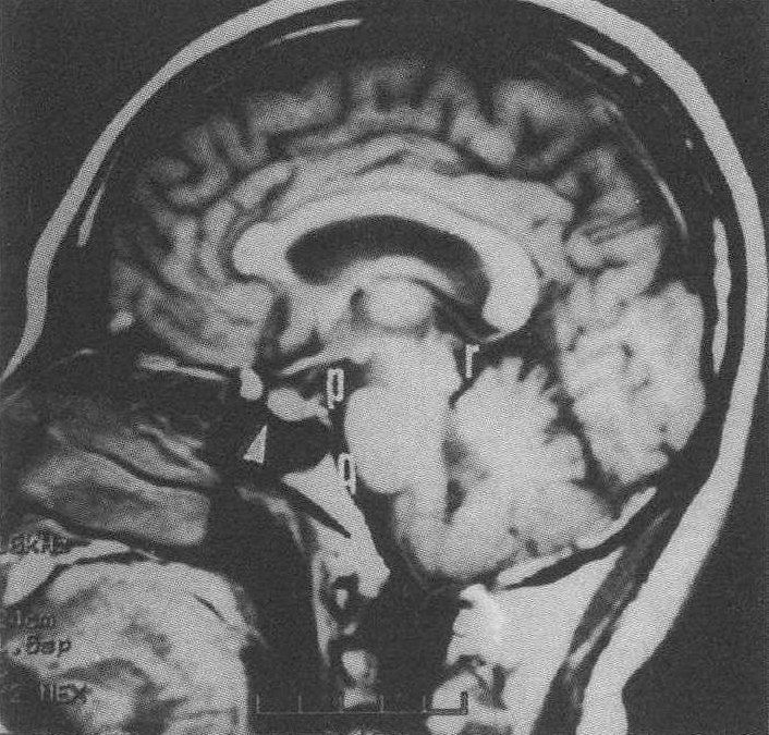 脑正中线旁矢状切面MRI图 (T<sub>1</sub>W)